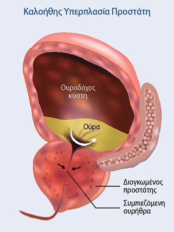 Βήματα για την αντιμετώπιση της υπερπλασίας του προστάτη-1
