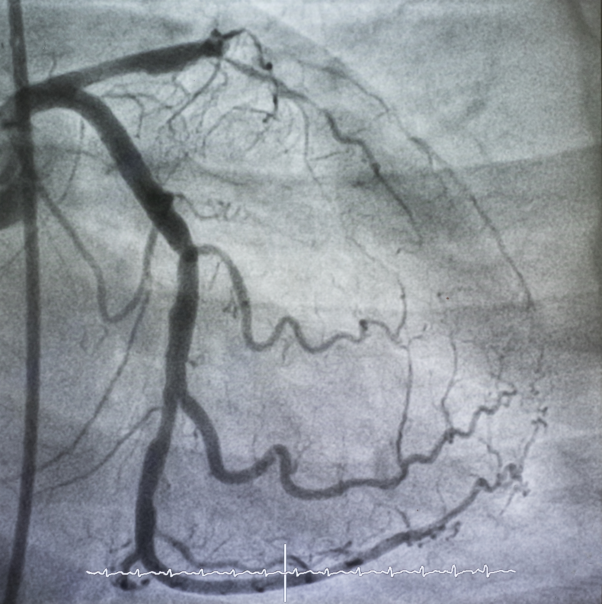 στεφανιαία-μικροαγγειακή-δυσλειτουρ-562280323