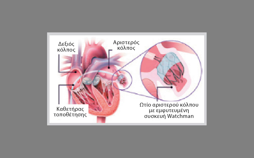 Πρόληψη του αγγειακού εγκεφαλικού επεισοδίου στην κολπική μαρμαρυγή: Πέρα από τα αντιθρομβωτικά φάρμακα-1