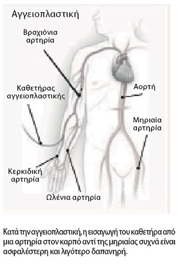 Είναι η διαδρομή από τον καρπό στην καρδιά ασφαλέστερη για την αγγειοπλαστική; -1