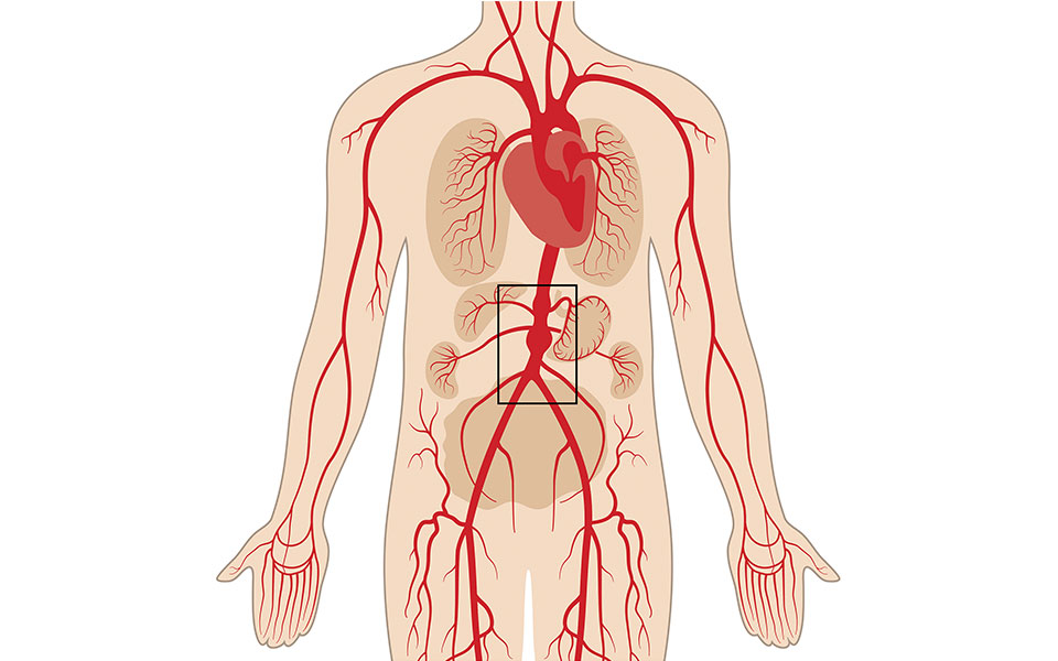 ανεύρυσμα-κοιλιακής-αορτής-σπάνιο-αλ-562376008