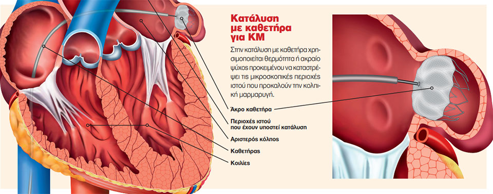Κατάλυση για την κολπική μαρμαρυγή-1