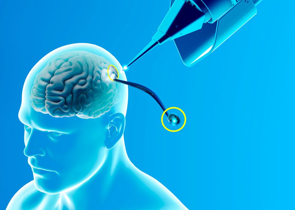 η-εταιρεία-εγκεφαλικών-τσιπ-του-ελον-μ-562441309