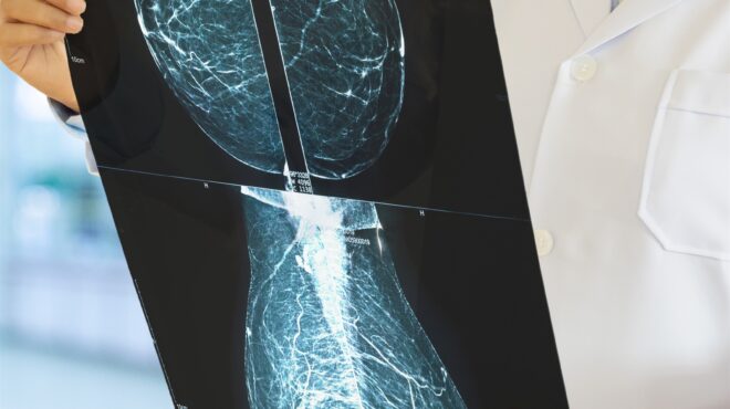 τεχνητή-νοημοσύνη-κατά-του-καρκίνου-τ-562551508