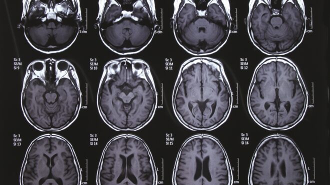 οι-καρδιακές-προσβολές-μπορεί-να-επιτ-562610611