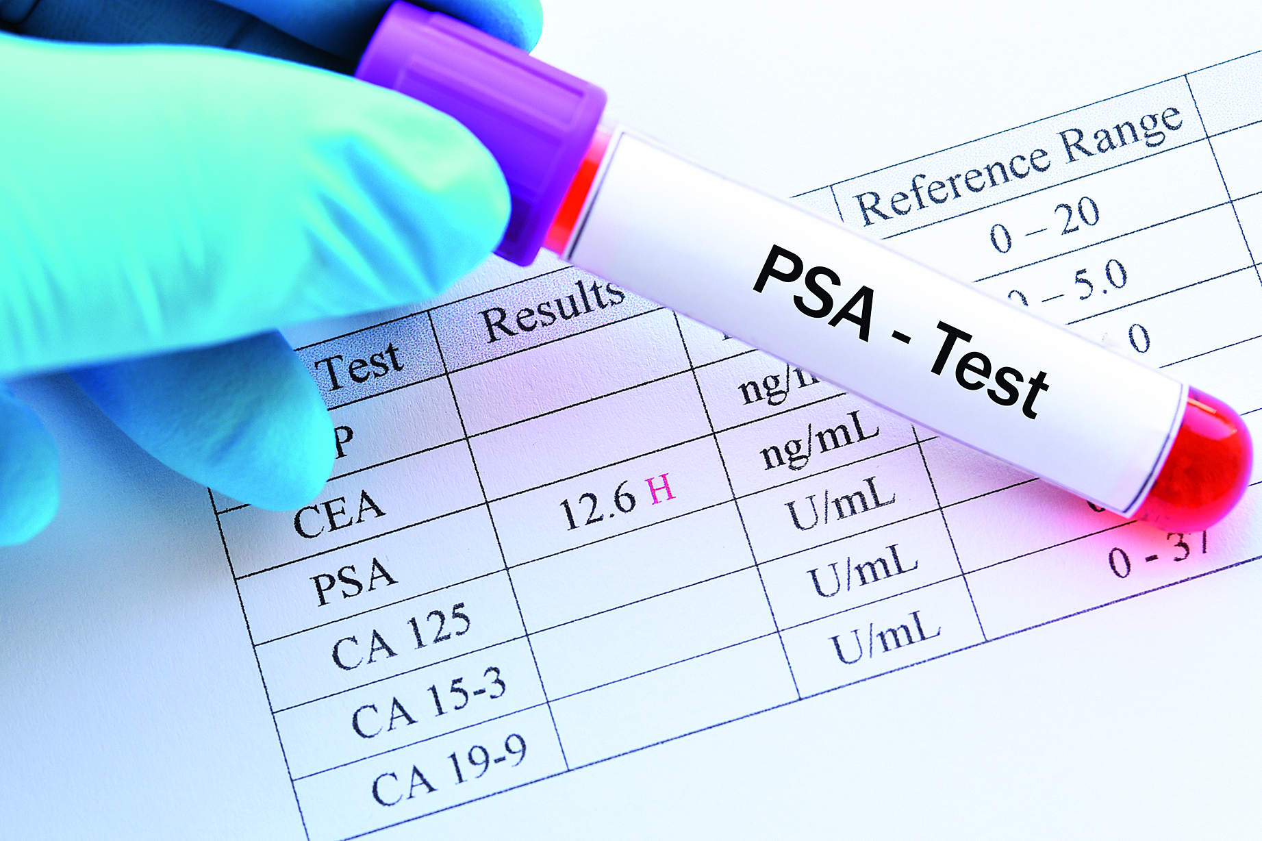 Νέα θεώρηση του τεστ PSA-1
