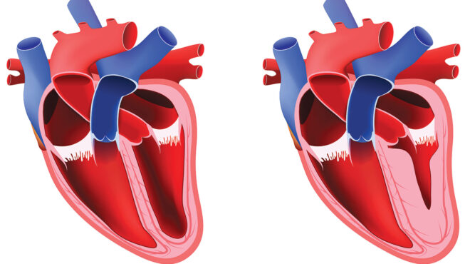 πρόοδος-στη-διαχείριση-της-υπερτροφι-562716664