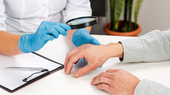 ψωρίαση-μην-την-αφήνεις-να-σε-απομακρύ-562719922