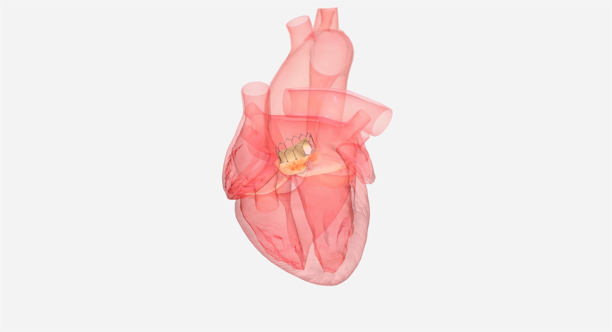 Επιδιόρθωση μιας ελαττωματικής αορτικής βαλβίδας-1