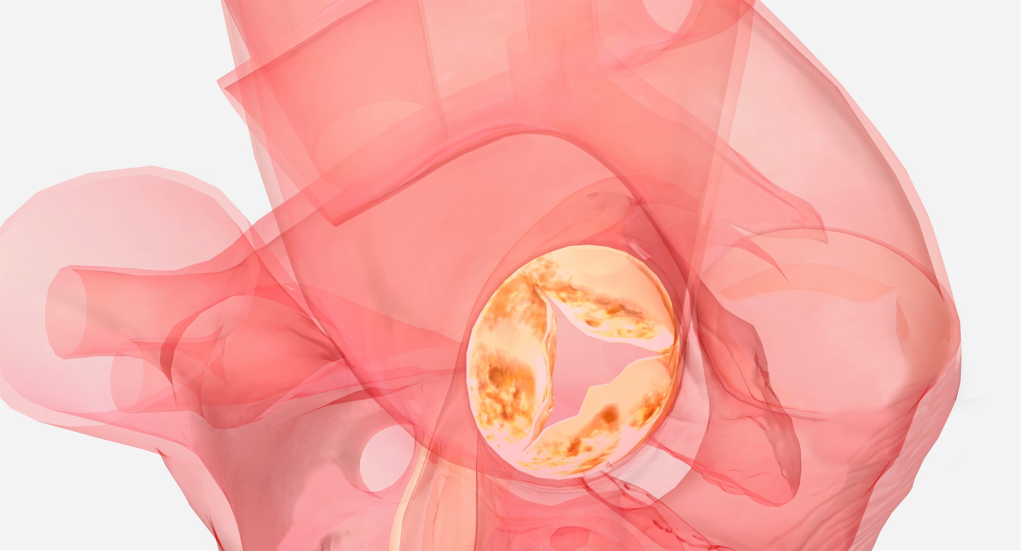 Επιδιόρθωση μιας ελαττωματικής αορτικής βαλβίδας-2