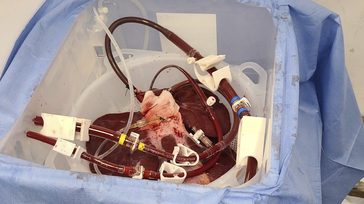 Επαναστατικό πείραμα: Εκαναν «αιμοκάθαρση» σε άνθρωπο μέσω ήπατος χοίρου-1