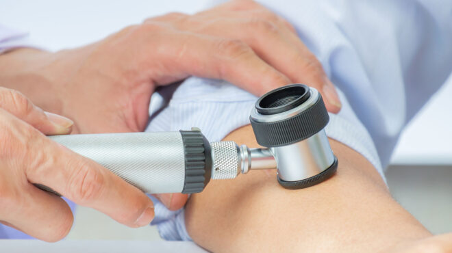 δερματικό-μελάνωμα-μια-60χρονη-η-πρώτη-562834717