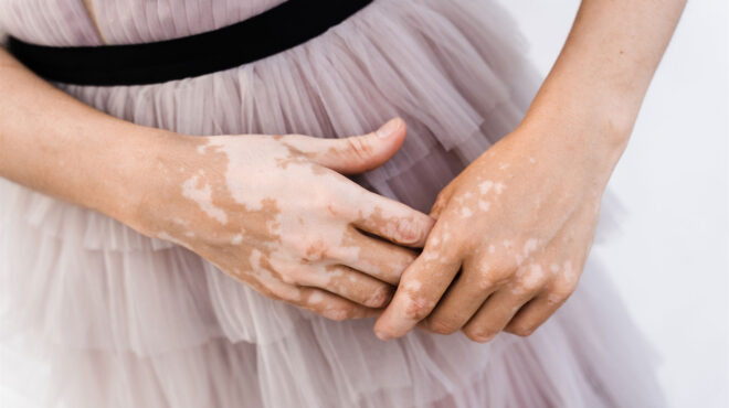 τι-πυροδοτεί-υποκείμενα-αυτοάνοσα-νο-562889539