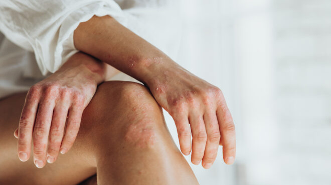 δαμάζοντας-τη-χρόνια-φλεγμονή-της-ψωρ-562908400