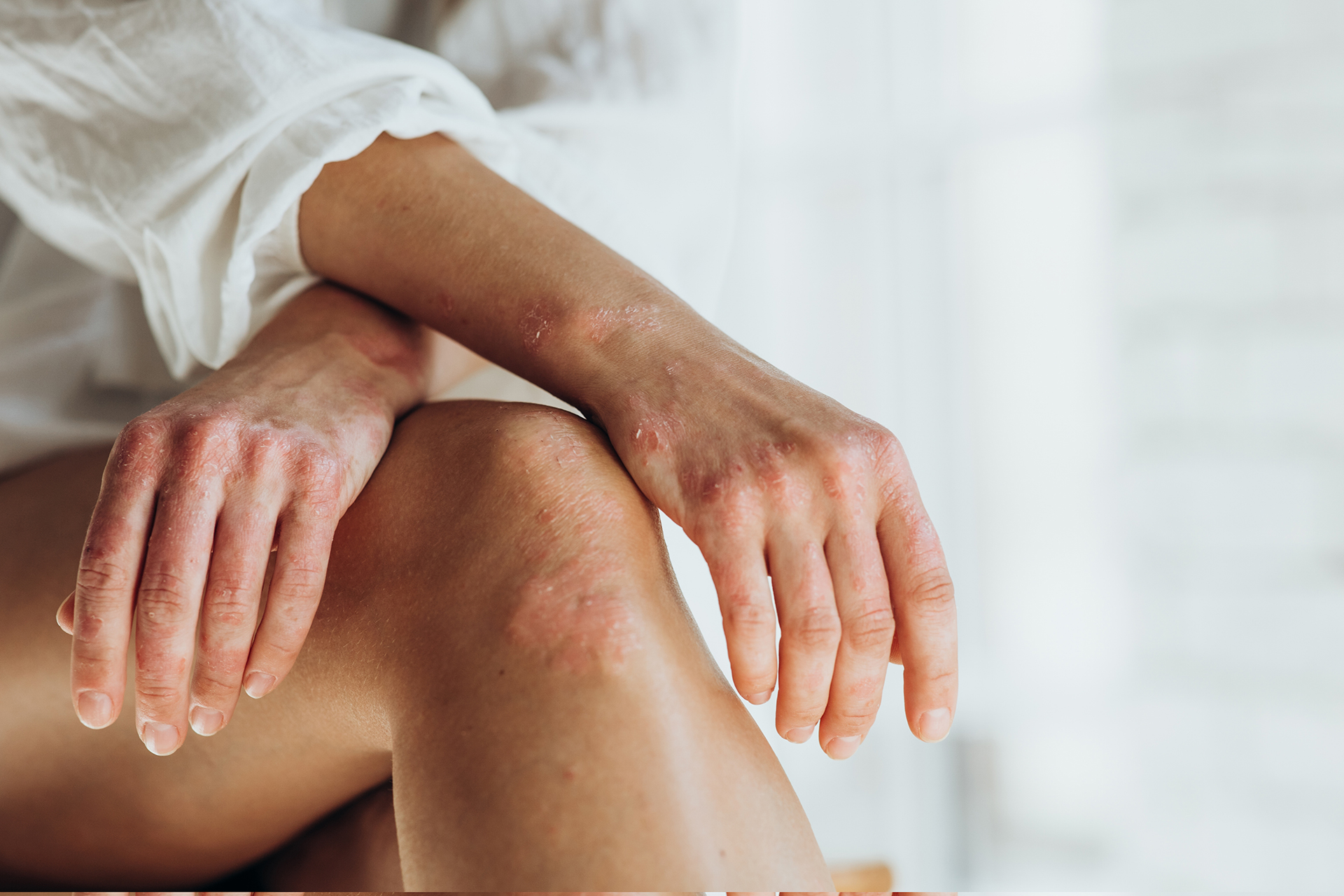 δαμάζοντας-τη-χρόνια-φλεγμονή-της-ψωρ-562908400