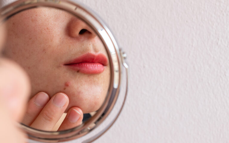 ΗΠΑ: Υψηλά επίπεδα καρκινογόνου ουσίας εντοπίστηκαν σε προϊόντα για την ακμή