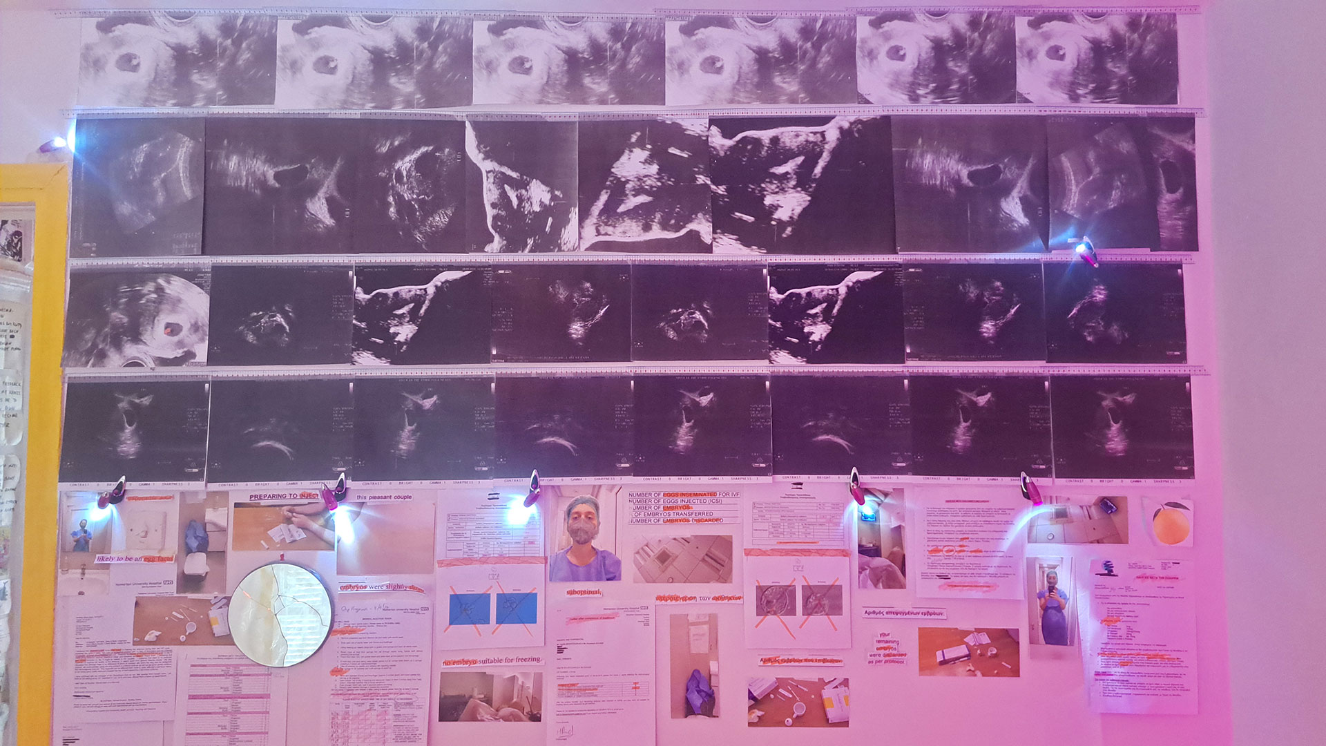 Το τραύμα της «α-γονιμότητας», η ελπίδα και η ματαίωση σε ένα δωμάτιο-2