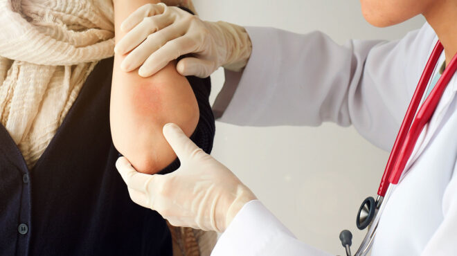 το-ευρύ-φάσμα-των-επιπτώσεων-της-ψωρία-563015458