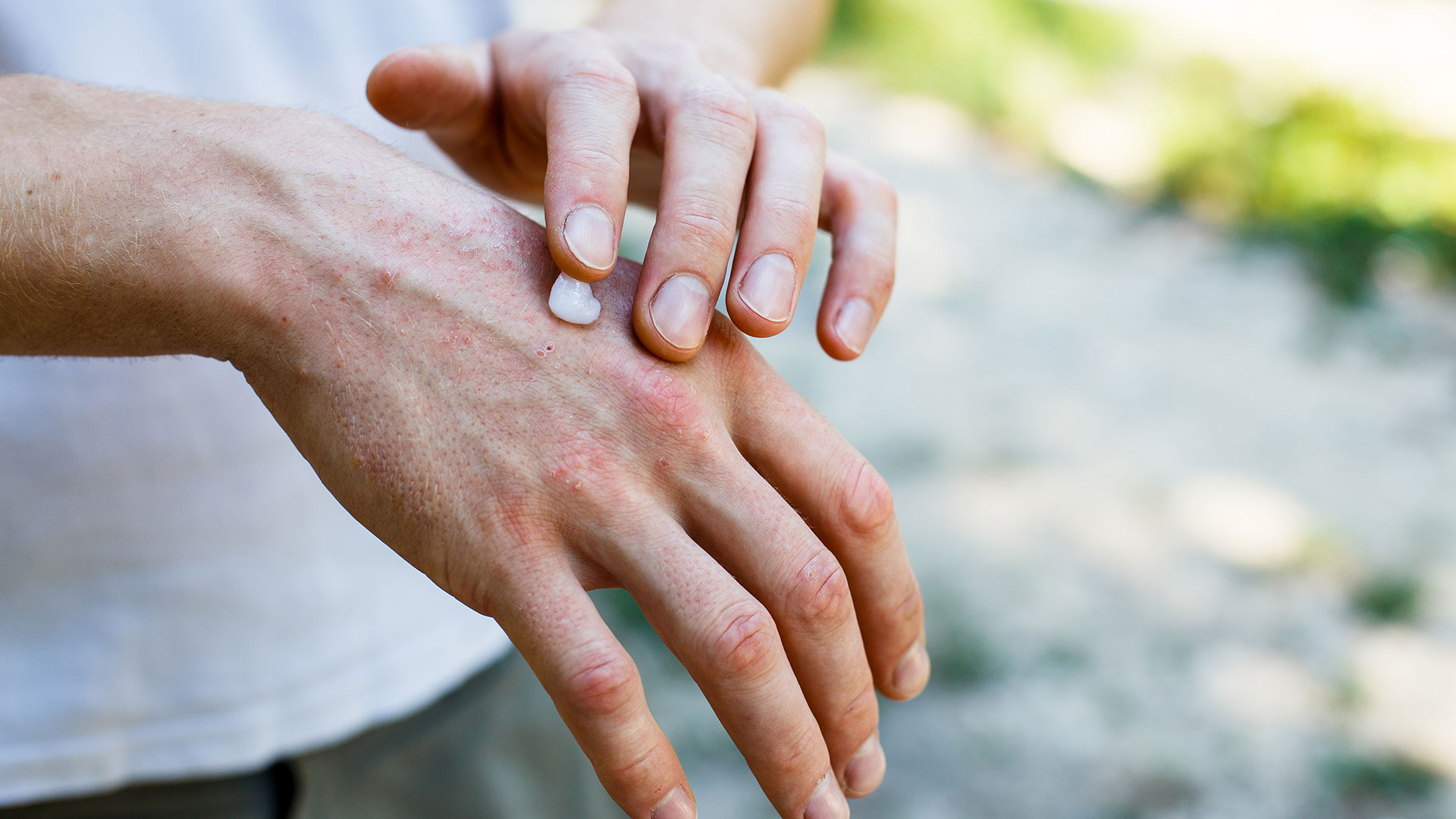 Το ευρύ φάσμα των επιπτώσεων της ψωρίασης-2