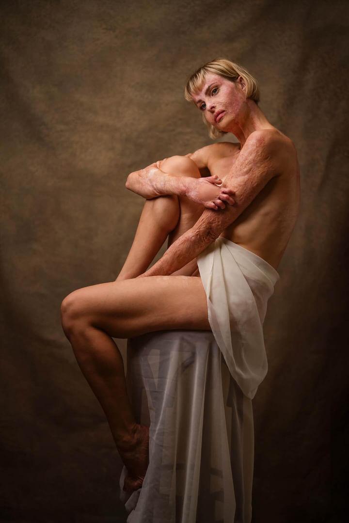 Ζώντας με το έγκαυμα-2