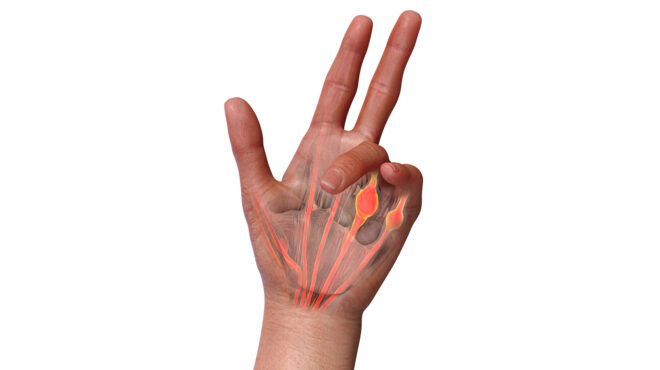 οι-καλύτερες-θεραπείες-για-ένα-συχνό-π-563087371