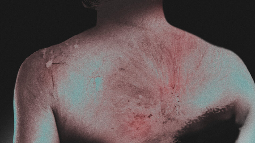 ζώντας-με-το-έγκαυμα-563085313