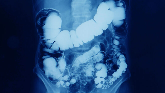 καρκίνος-παχέος-εντέρου-τι-περιλαμβά-563061727