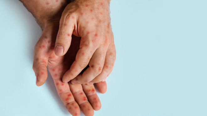 ευλογιά-των-πιθήκων-γιατί-έχουμε-έξαρ-563175394