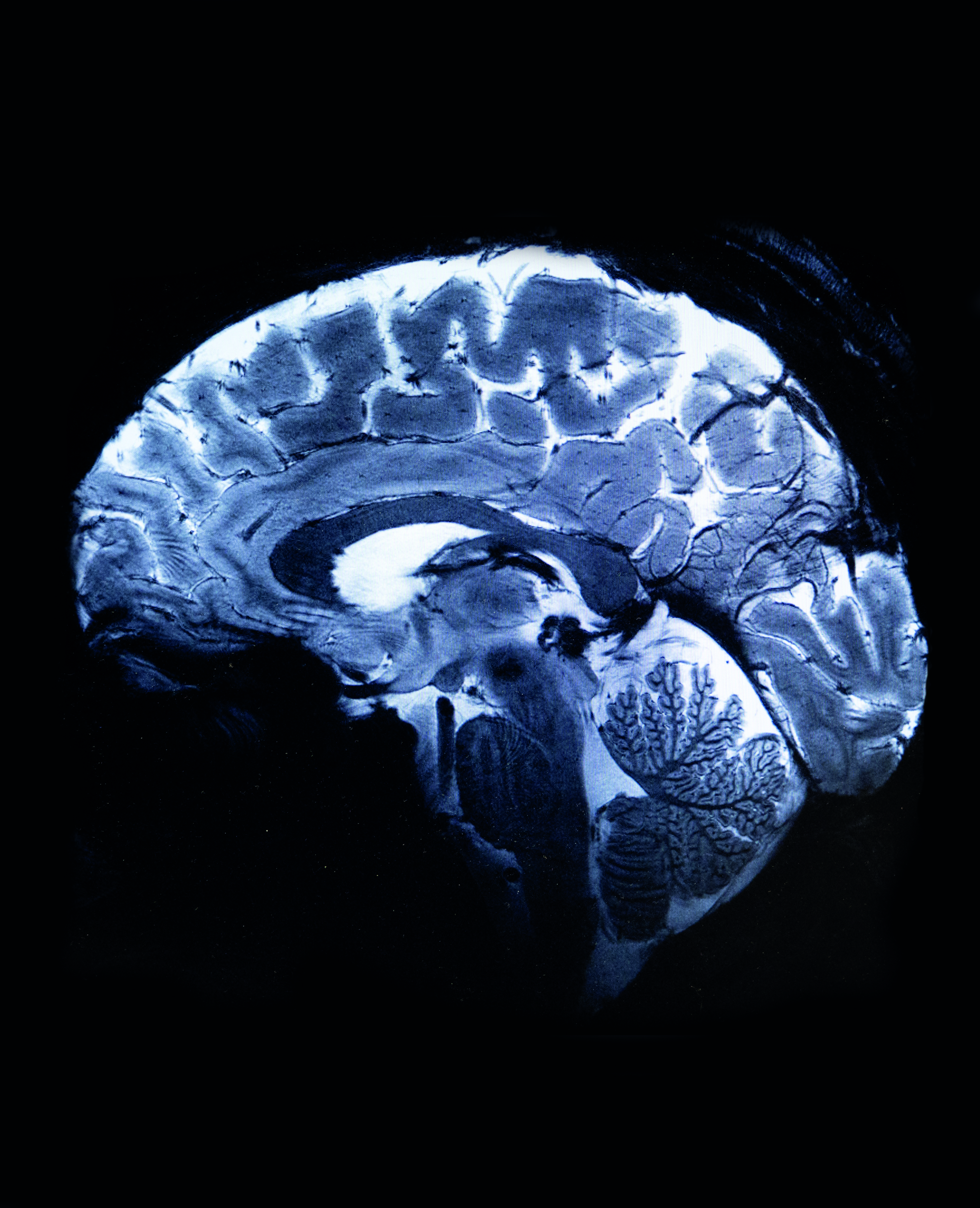 Γιατί ο Ελον Μασκ επενδύει πολλά δισ. δολάρια σε εγκεφαλικά εμφυτεύματα;-2