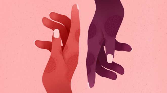 η-πιο-συχνή-δερματική-νόσος-και-πώς-να-τ-563344189