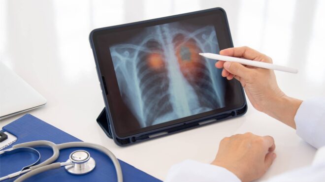 καρκίνος-του-πνεύμονα-παγκόσμια-παν-563343724