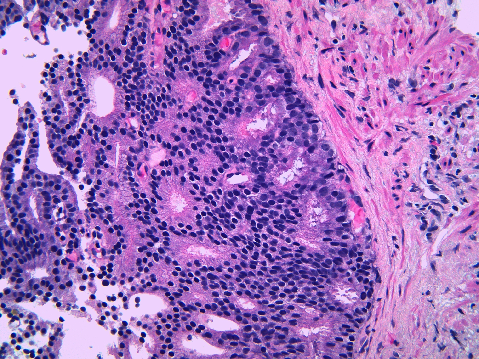 Οι κρυφοί κίνδυνοι του προδιαβήτη-1