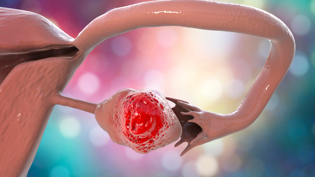 ενας-καλά-κρυμμένος-φονικός-καρκίνος-563359522