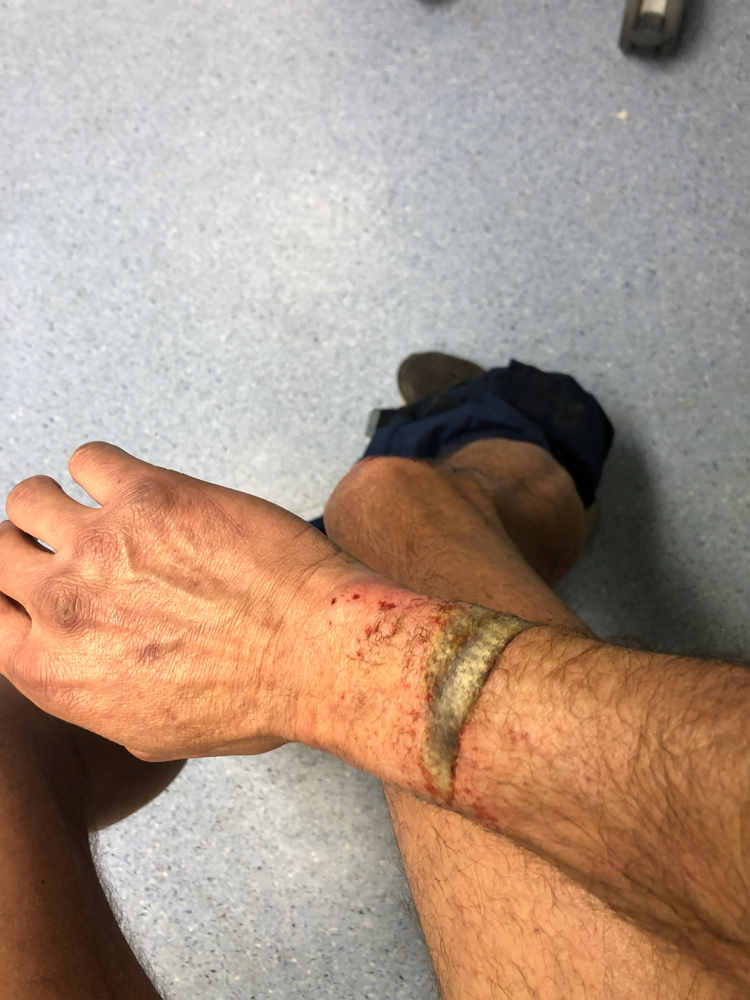 Τέμπη: Ο πυροσβέστης με τα χημικά εγκαύματα μιλάει στην «Κ»-1