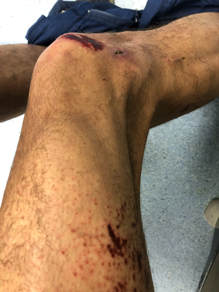 Τέμπη: Ο πυροσβέστης με τα χημικά εγκαύματα μιλάει στην «Κ»-3