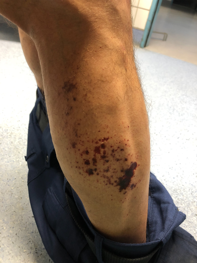 Τέμπη: Ο πυροσβέστης με τα χημικά εγκαύματα μιλάει στην «Κ»-2