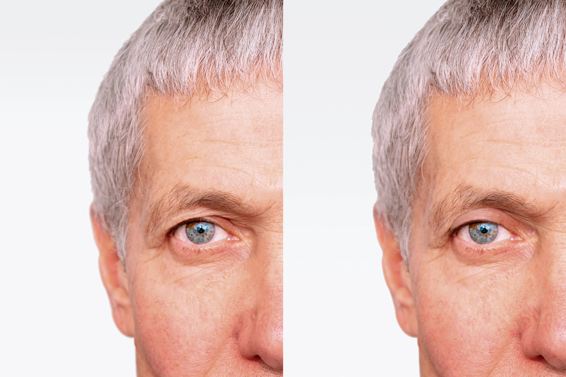 Τι περιλαμβάνει πραγματικά η βλεφαροπλαστική;-1