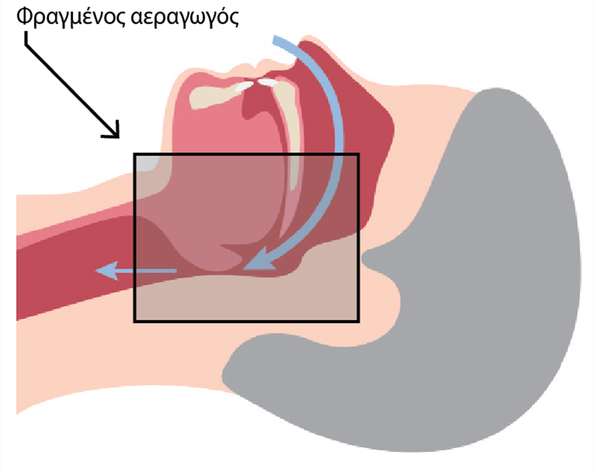 Υπνική άπνοια και καρδιοπάθεια: ένα σημαντικό θέμα-1