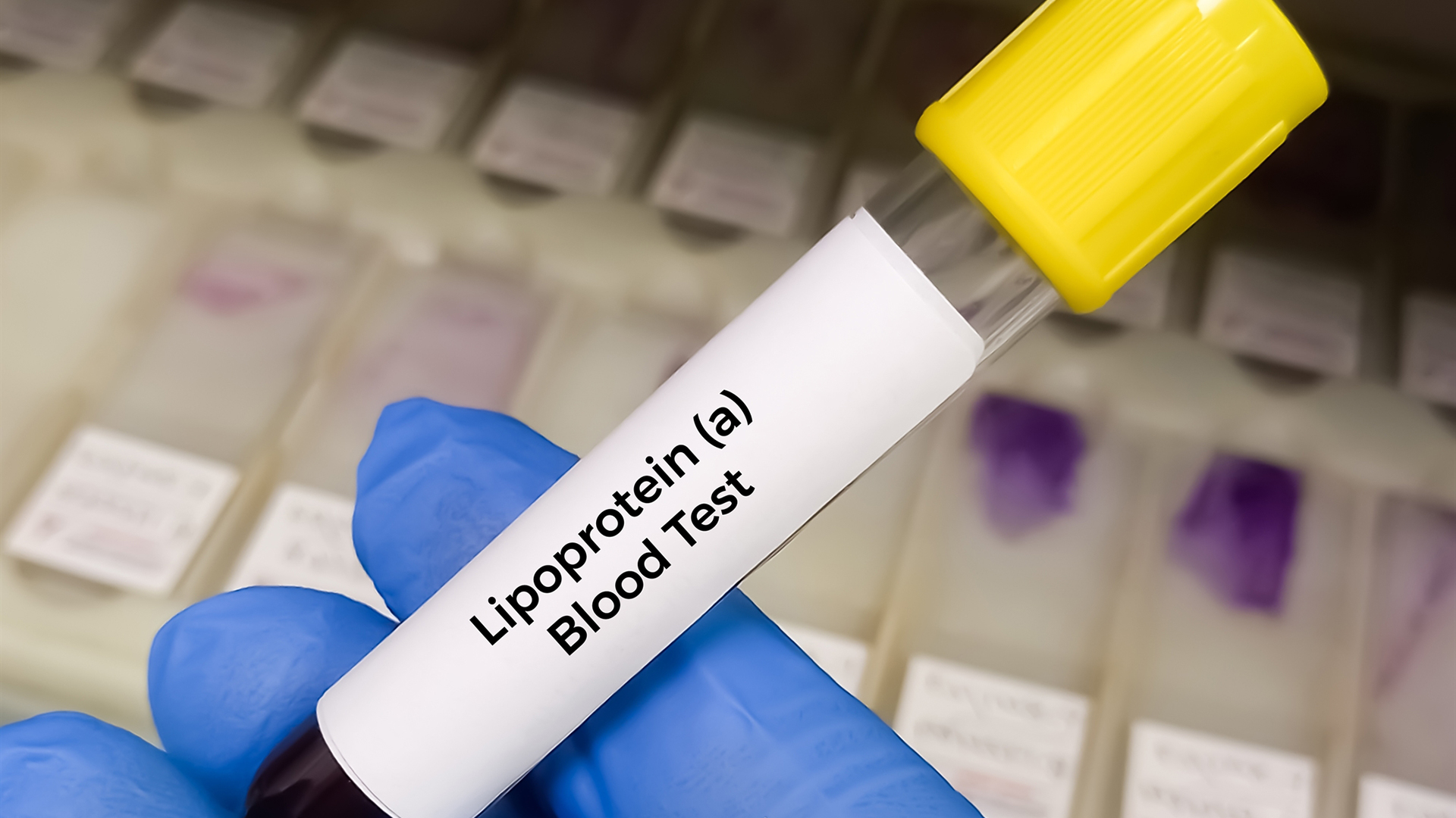 λιποπρωτεΐνη-α-νεότερα-για-τις-εξετάσ-563576965
