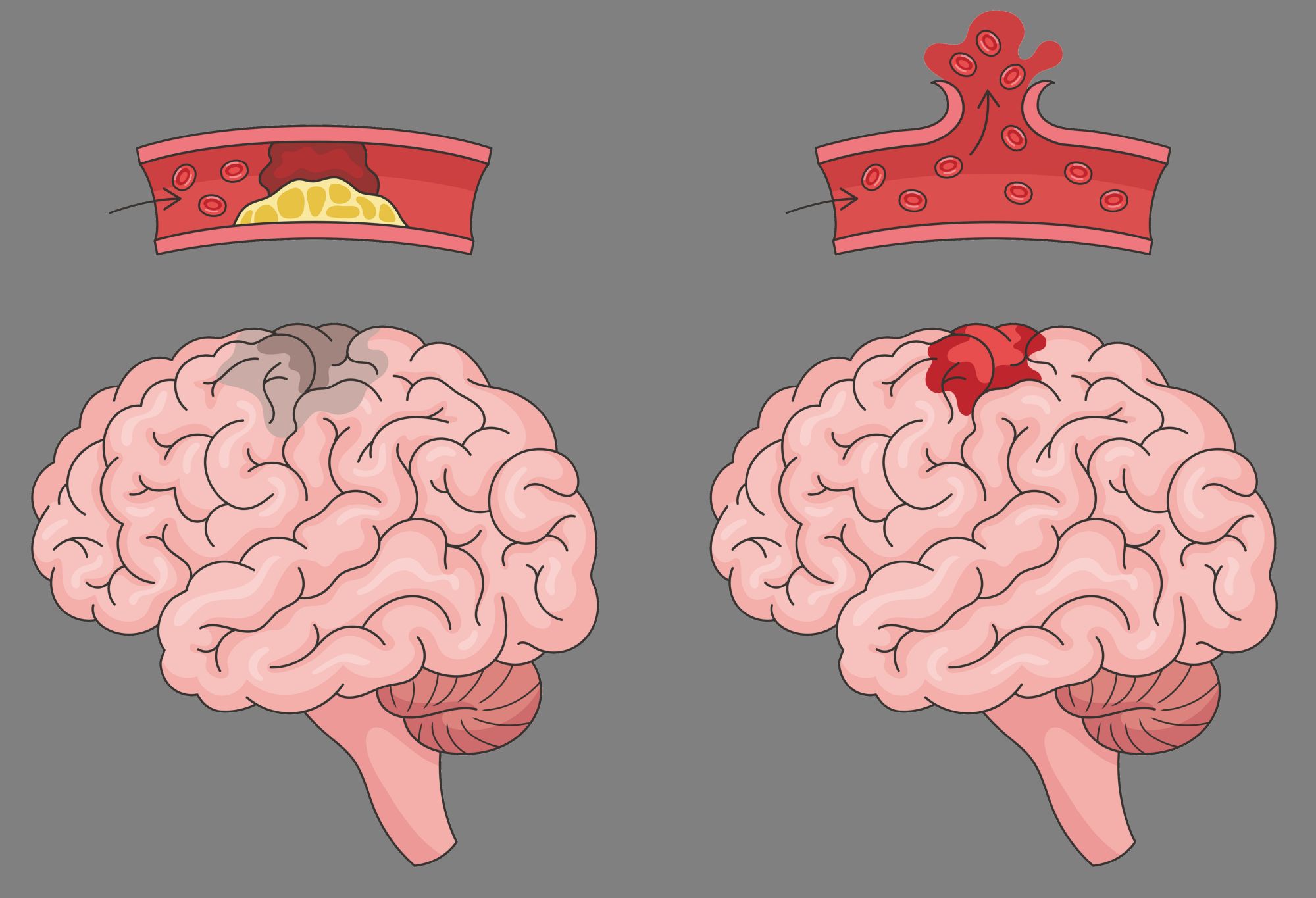Ποιοι είναι οι διάφοροι τύποι «εγκεφαλικής προσβολής»-3