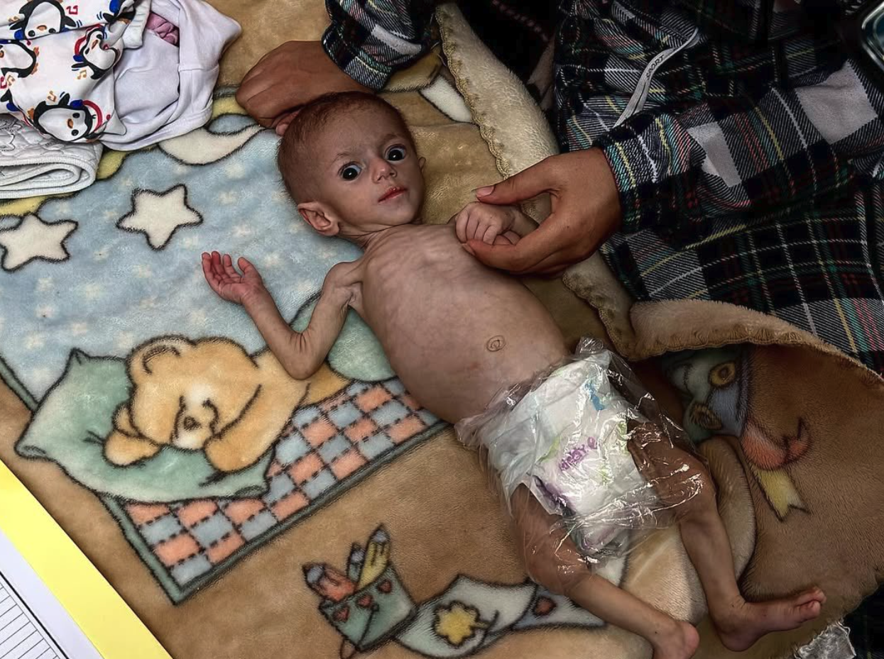 γάζα-η-εικόνα-ενός-αποστεωμένου-μωρού-563608036