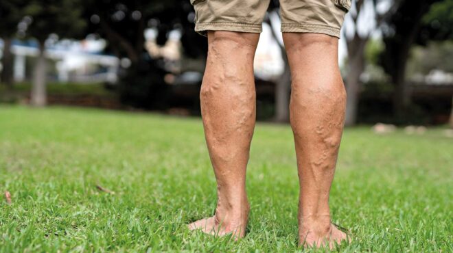 κιρσοί-eνα-πρόβλημα-που-δεν-είναι-μόνο-563624581