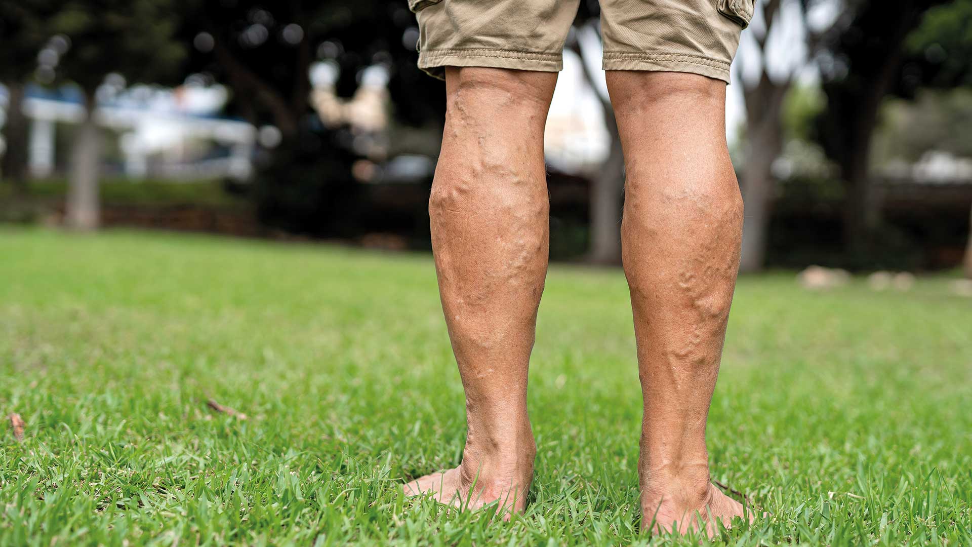 κιρσοί-eνα-πρόβλημα-που-δεν-είναι-μόνο-563624581