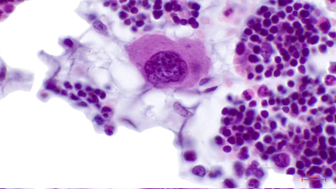 eνας-παράγοντας-καρδιοπάθειας-που-ελλ-563601316