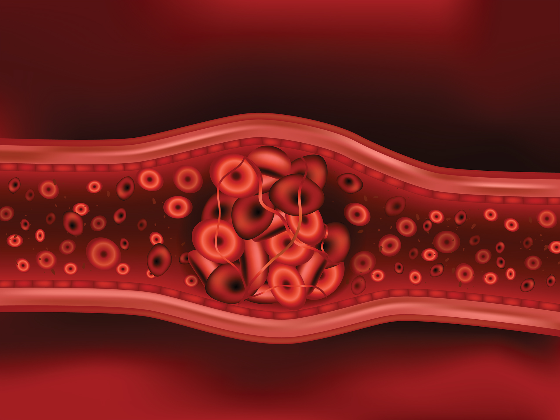 Πάρτε το πάνω χέρι στην εν τω βάθει φλεβική θρόμβωση-1