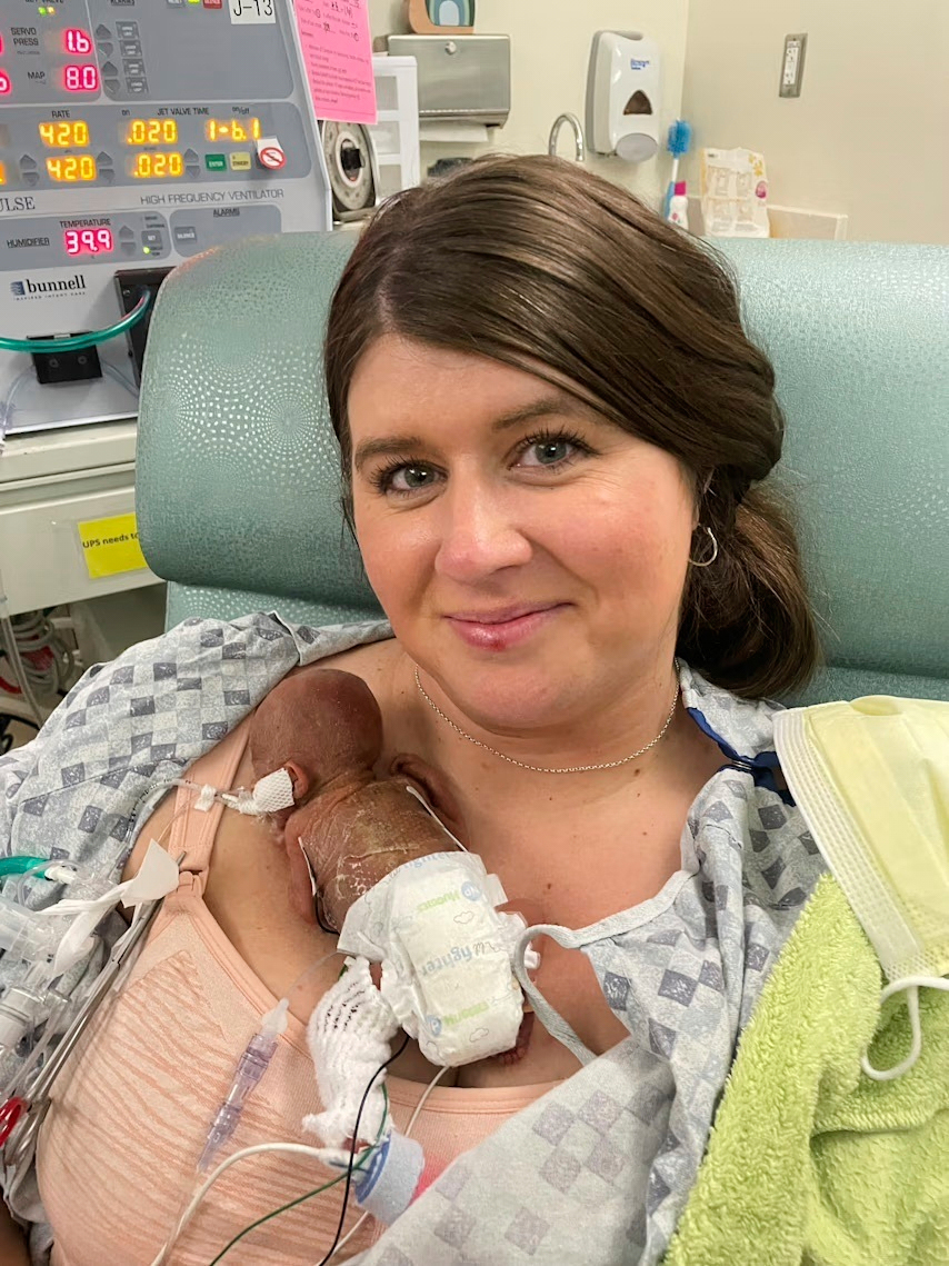 Το πιο πρόωρο μωρό του κόσμου γιορτάζει τα πρώτα του γενέθλια-1