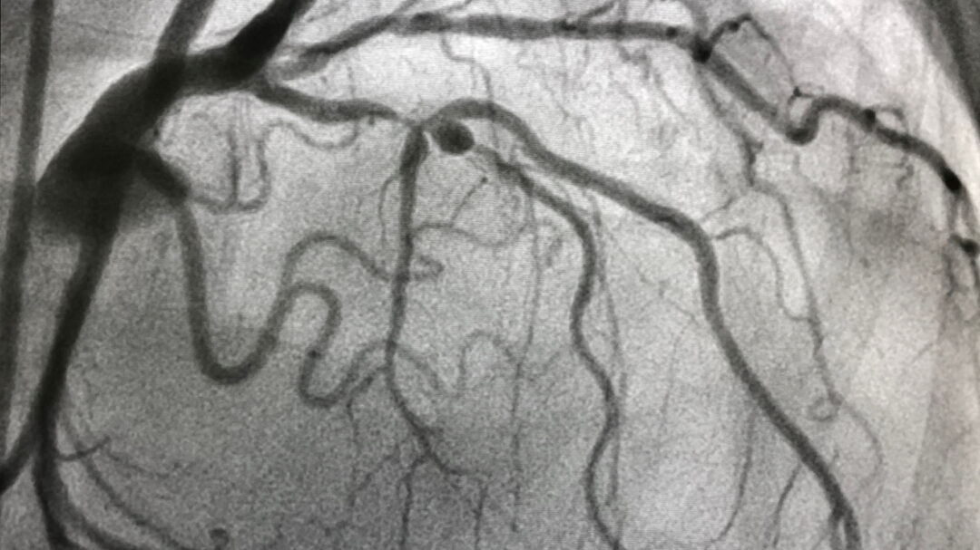 παρατηρώντας-τις-στεφανιαίες-αρτηρί-563701978