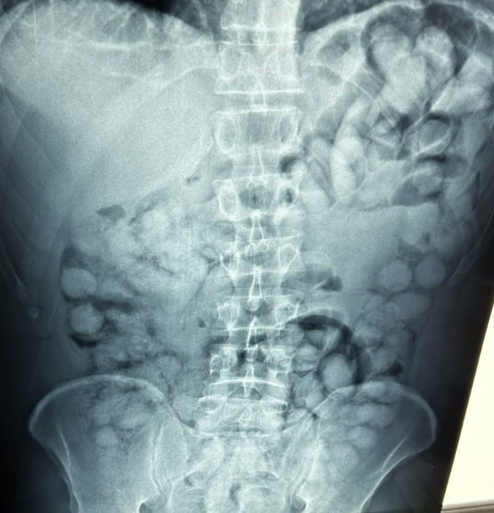 «Ελ. Βενιζέλος»: Συνελήφθη άνδρας που είχε καταπιεί 100 συσκευασίες κοκαΐνης – Φωτογραφίες-2