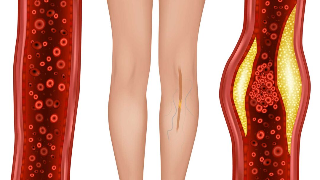 περιφερική-αρτηριοπάθεια-νεότερα-δε-563781067