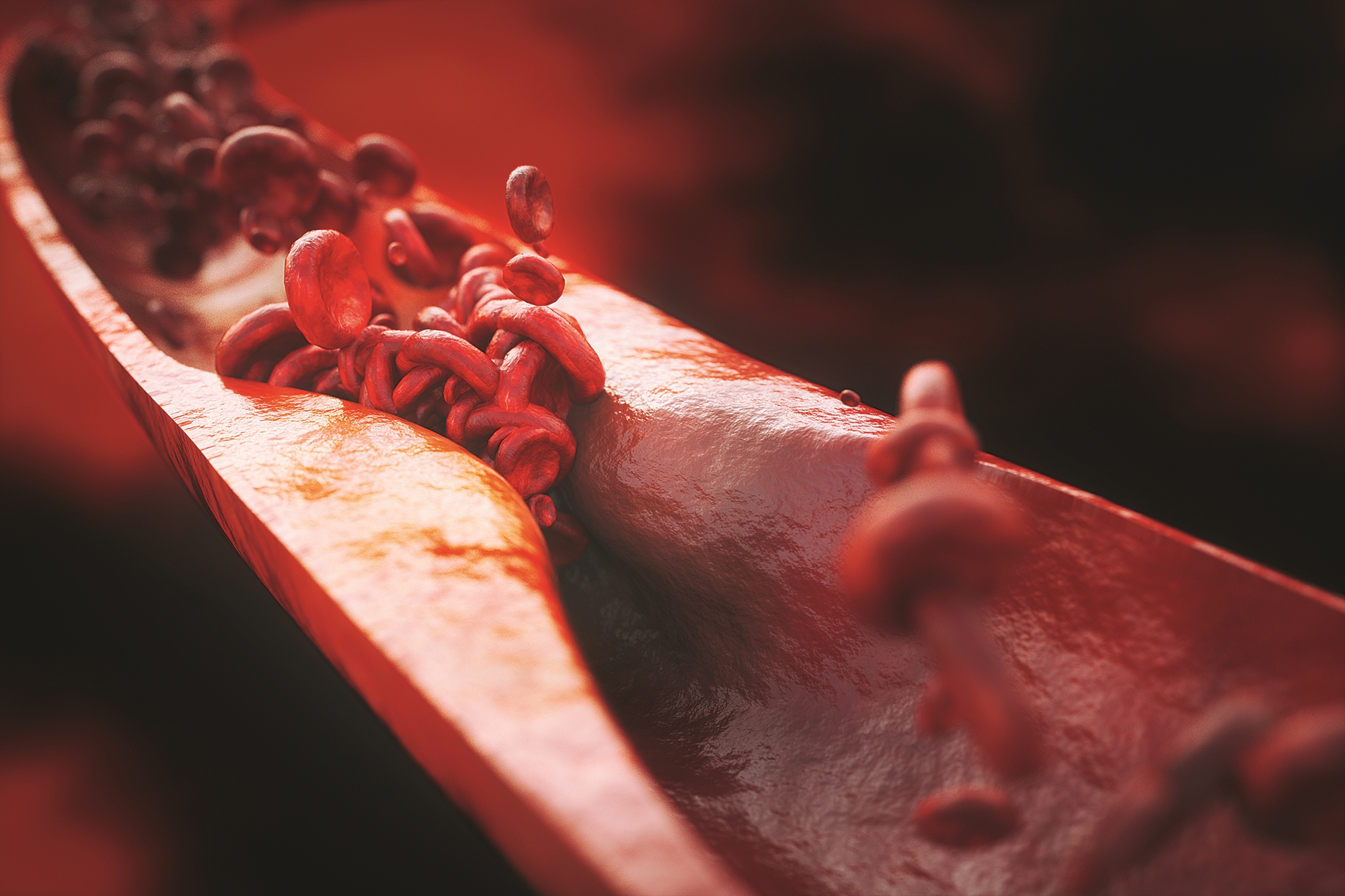 Μια νέα προσέγγιση για την περιφερική αρτηριοπάθεια-1